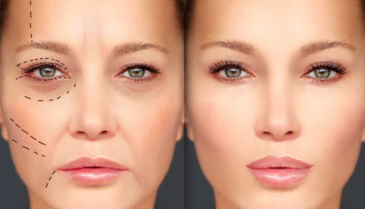 Wrinkles Come Back Worse After Fillers